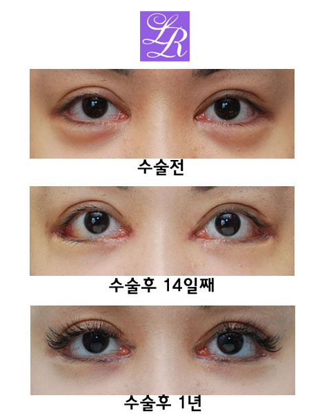 Simultaneous Medial and Lateral Canthoplasty Revision image 1
