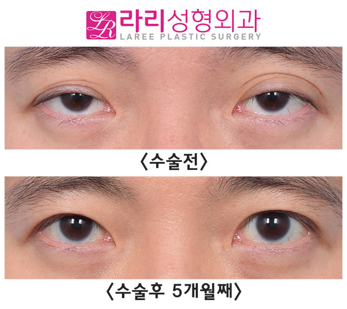 [라리성형외과] 쌍꺼풀없애기와 눈매교정수술의 콜라보 (+ 눈도 잘 감겨요) 관련 이미지 1