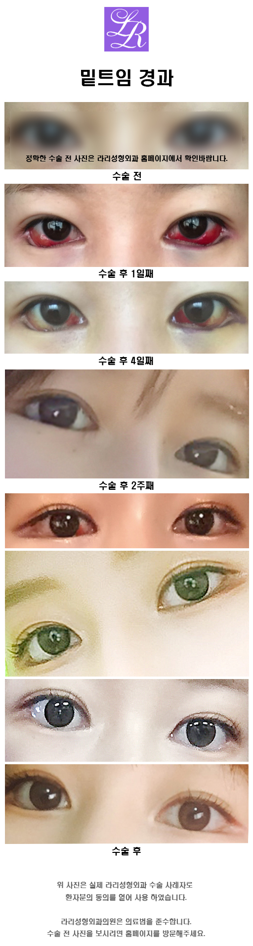 Lowering Upturned Outer Corners, Barbie Doll Lower Eye Widening image 5