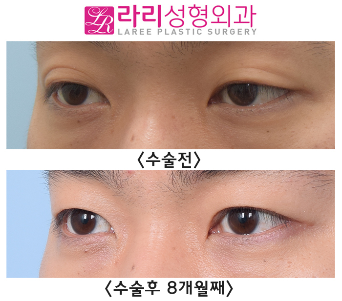 [라리성형외과] 쌍꺼풀없애는수술, 남자라면 꼭 고려해 보세요. 관련 이미지 3