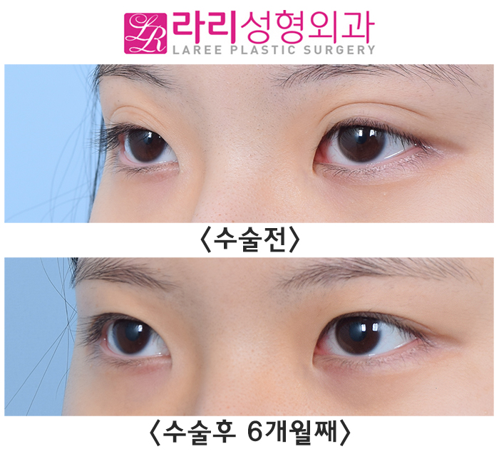 [라리성형외과] 매몰 쌍수가 풀리면 쌍꺼풀 재수술? NoNo 쌍꺼풀 없애기! 관련 이미지 4