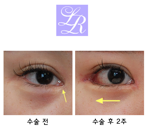 Can medial canthoplasty revision, lateral canthoplasty revision, and under-eye fat repositioning be done at the same time? image 1