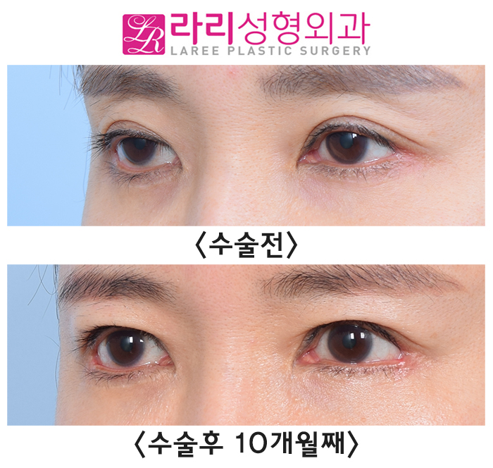 [Lari Plastic Surgery] Sunken Upper Eyelids -> Loop Fat Grafting -> Before-and-After Sunken-Eye Correction Photos image 4
