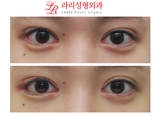 Before-and-After Photos of Micro Outer Canthoplasty with Lowering of the Outer Eye Corner☆ image 1