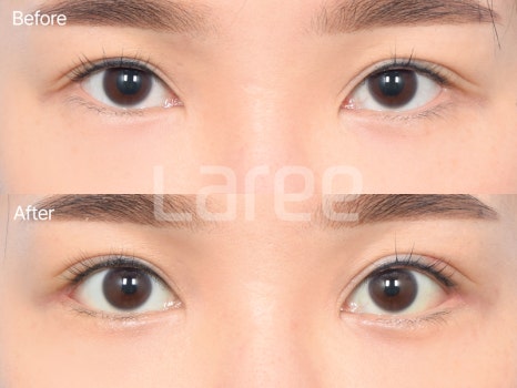 [LaLi Plastic Surgery] Outer Canthus Lowering Surgery, If It’s a Revision Surgery, It Must Be Done at a Place That Does It Well. image 8