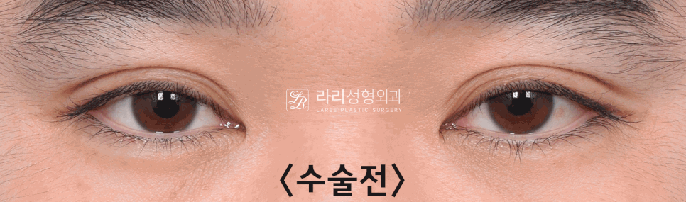 [라리성형외과] 무절제 겉쌍꺼풀없애기 무쌍수술 전후 (+절개와 절제의 차이) 관련 이미지 2