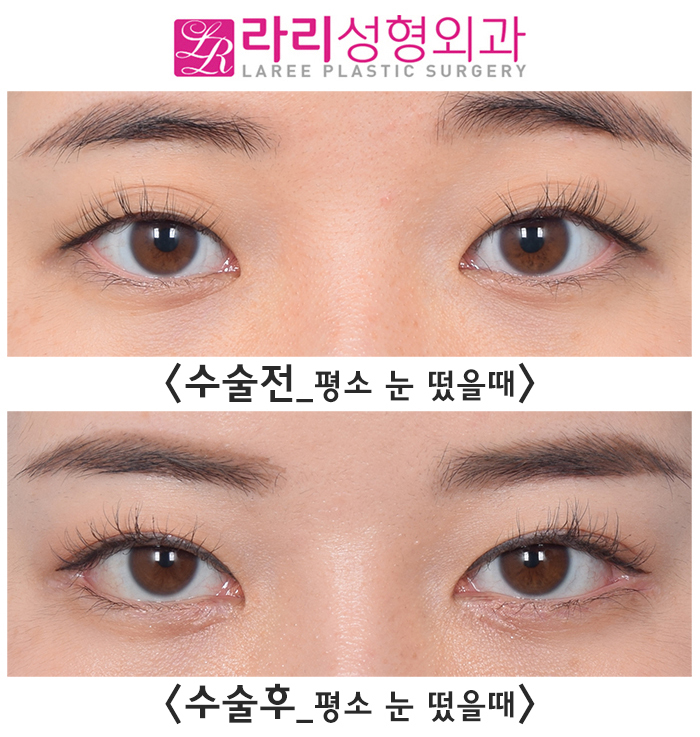 [라리성형외과] 이마보톡스가 눈 모양이나 쌍꺼풀 라인에 미치는 영향에 대하여 관련 이미지 6