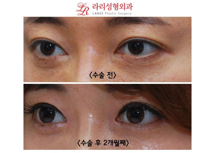 앞트임 복원 전후사진 (수술 2개월후와 1년후) 관련 이미지 3