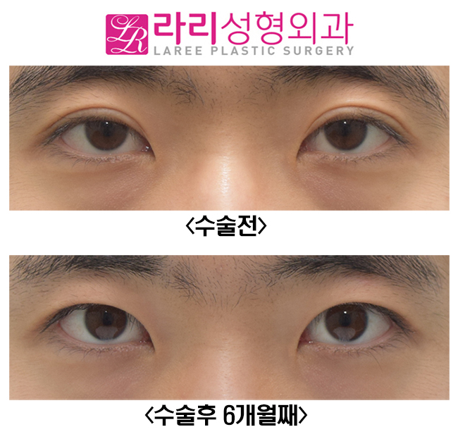 [Rari Plastic Surgery] Eliminating Thick Double Eyelids with a Near-No-Double-Eyelid Inner Fold image 1