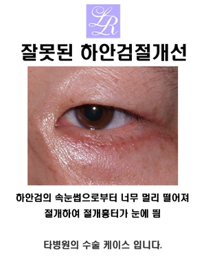 Lower Eyelid Surgery for Sagging Eyes — Lower Blepharoplasty to Correct Under-Eye Sagging image 3