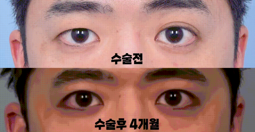 [라리성형외과] 쌍꺼풀없애기 무쌍수술, 자연스러운 변화와 눈 깜빡임을 확인하세요. 관련 이미지 4
