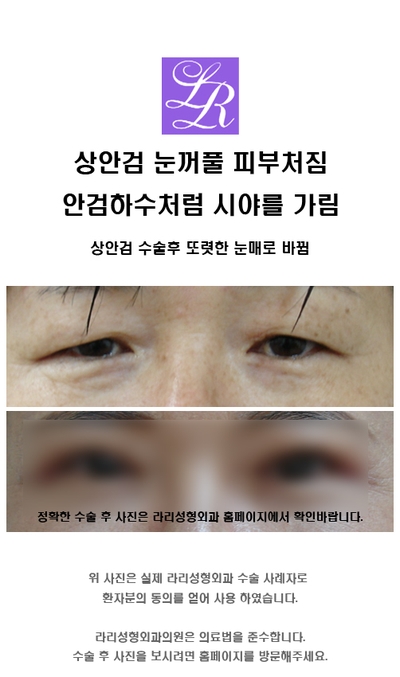 Is eyelid drooping a symptom of ptosis? image 3