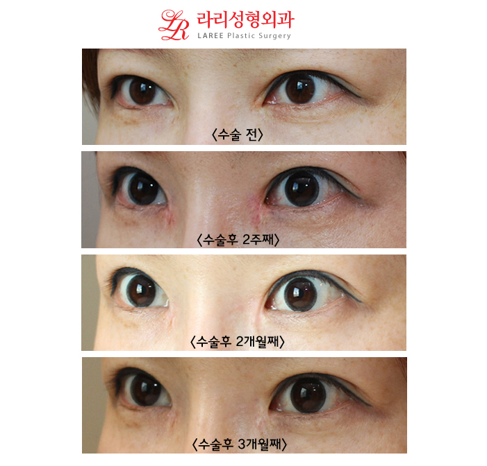 The Standard of Epicanthoplasty Restoration/Epicanthoplasty Reconstruction/Mongolian Fold Restoration/Mongolian Fold Reconstruction: 3D Epicanthoplasty Restoration Before-and-After Photos image 2