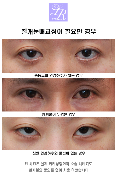 After Looking at Reviews of Incisional Double Eyelid Surgery image 3