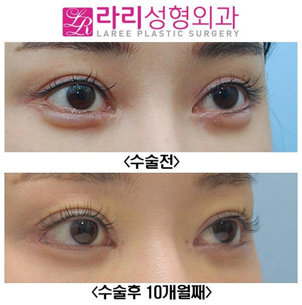 [Lari Plastic Surgery] Before-and-After Photos of Revision Canthoplasty for Downward Outer Eye Corners image 2