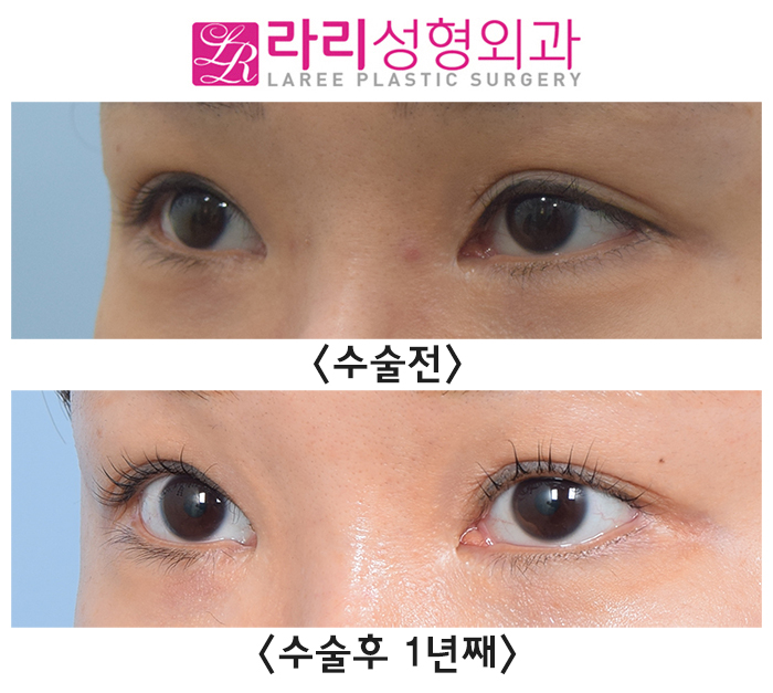 [라리성형외과] 수술 티 나지 않는 자연스러운 밑트임수술 전후 사진 관련 이미지 3