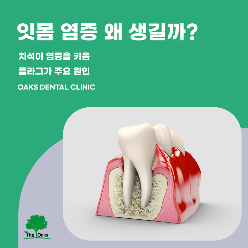 청담동치과 잇몸염증치료 반복되는 출혈을 가볍게 넘기지 마세요 관련 이미지 1