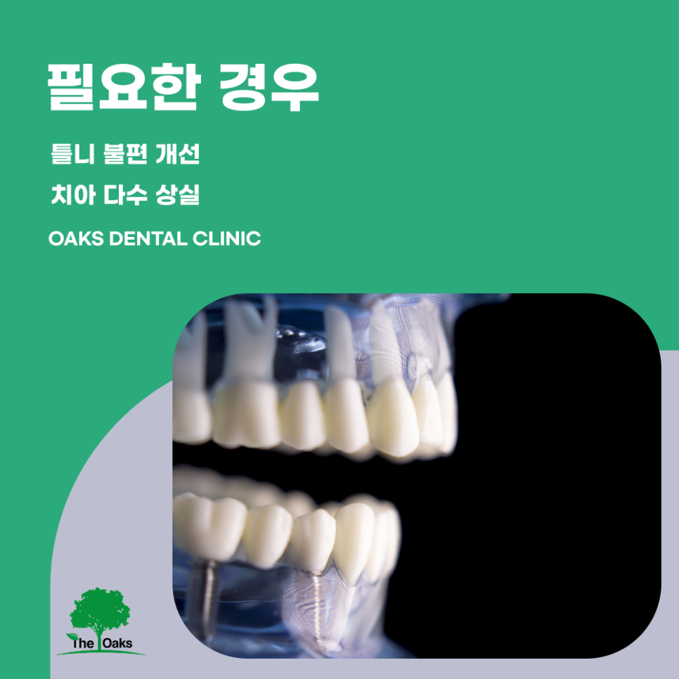 논현동치과 전체임플란트 여러 치아를 동시에 회복하는 체계적인 치료 관련 이미지 2