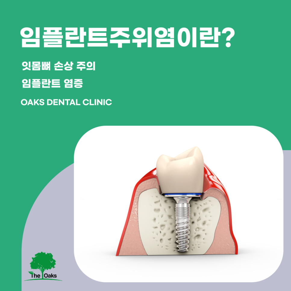 교대역치과 임플란트주위염 방치하면 임플란트 수명까지 위협할 수 있습니다 관련 이미지 1