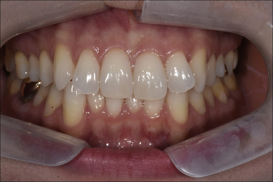 강남역치아교정 마스크 당당히 벗어요! 관련 이미지 1