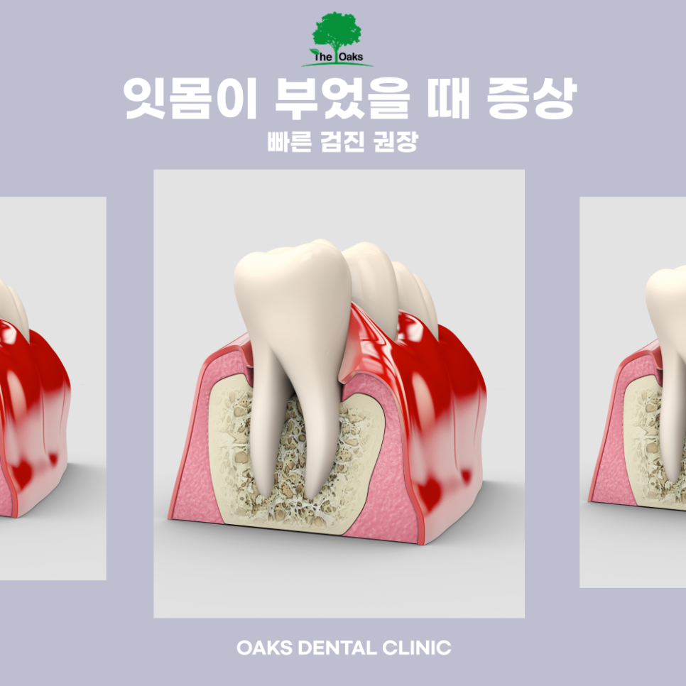 도곡동치과 잇몸부었을때 방치하지 말아야 하는 이유 관련 이미지 3