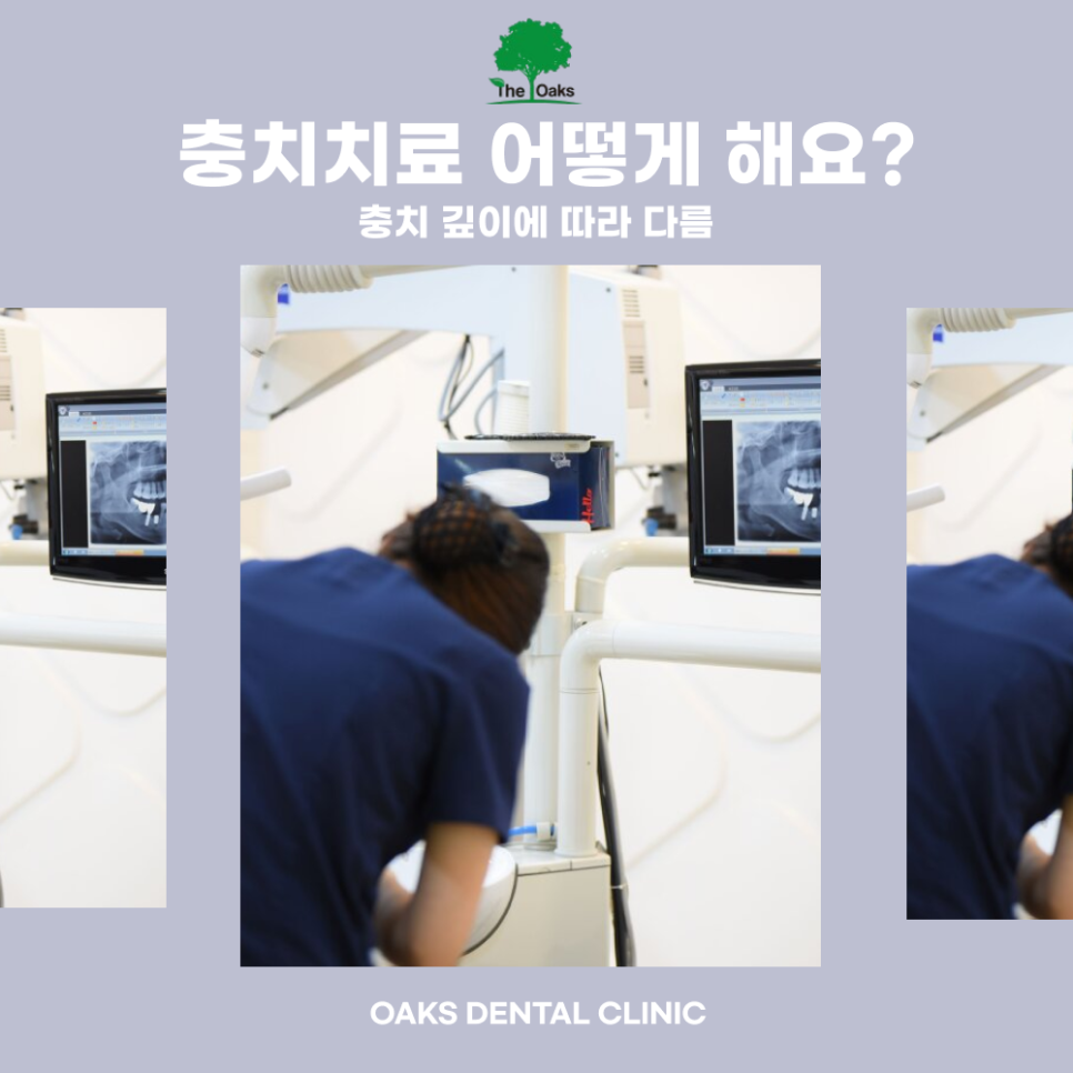 논현동치과 충치치료 아플 때가 아니라 생기기 전에 시작하세요 관련 이미지 4