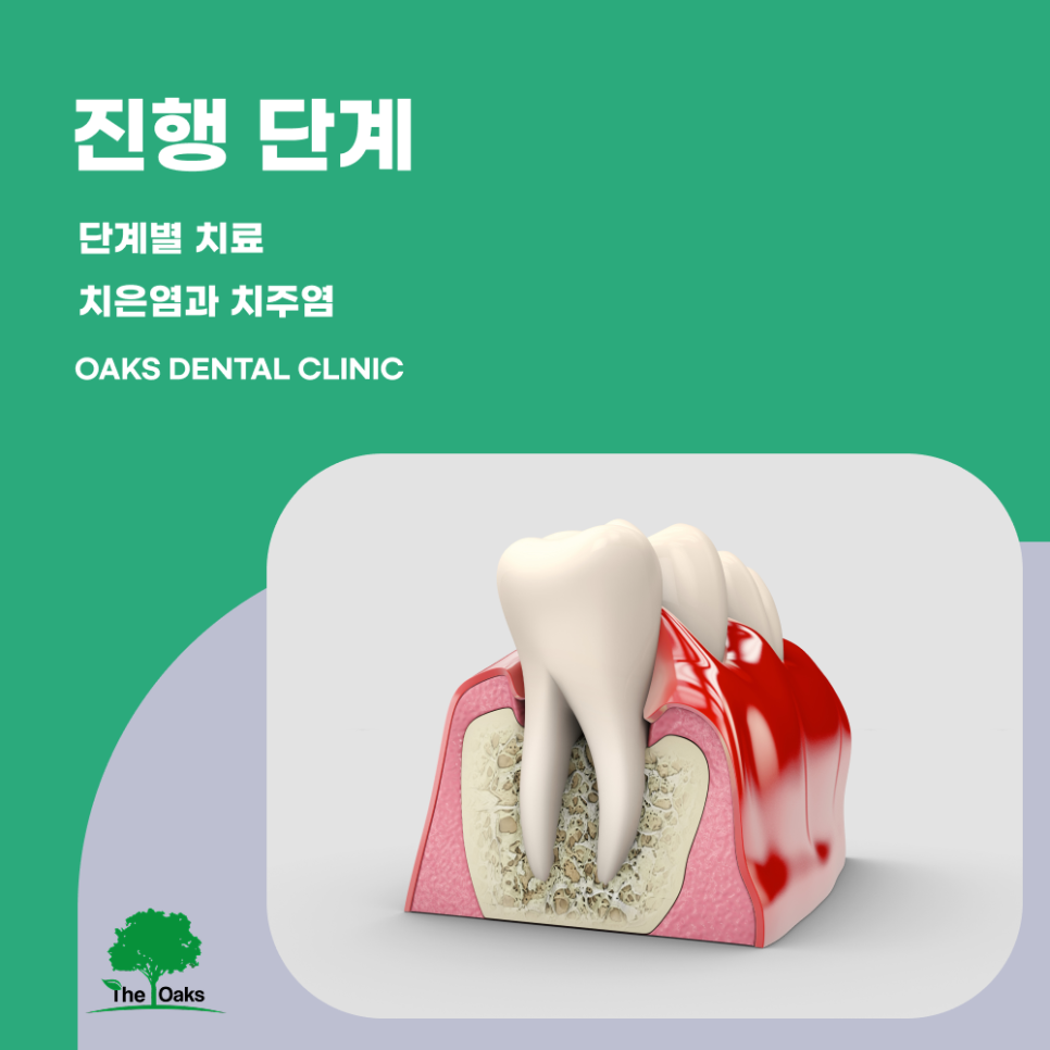 강남구치과 잇몸치료 치아를 오래 지키는 가장 기본적인 치료 관련 이미지 2