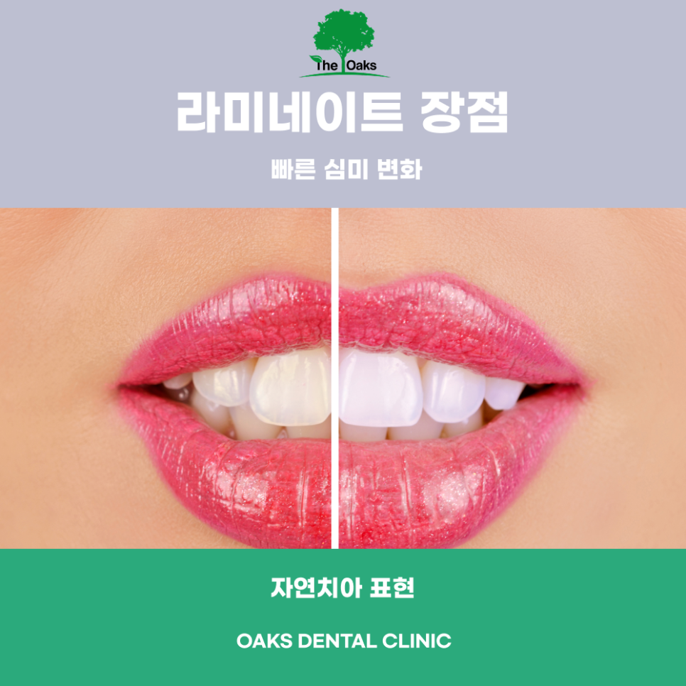대치동치과 라미네이트 자연스럽게 하고 싶다면 심미치료 전 꼭 알아야 할 핵심 정보 관련 이미지 3