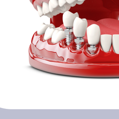 개포동치과 임플란트종류 나에게 맞는 선택이 중요한 이유 관련 이미지 15