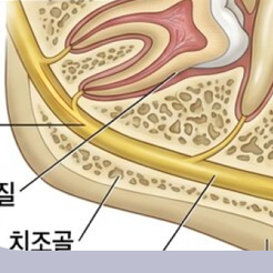 청담동치과 매복사랑니는 왜 발치할까요? 관련 이미지 15
