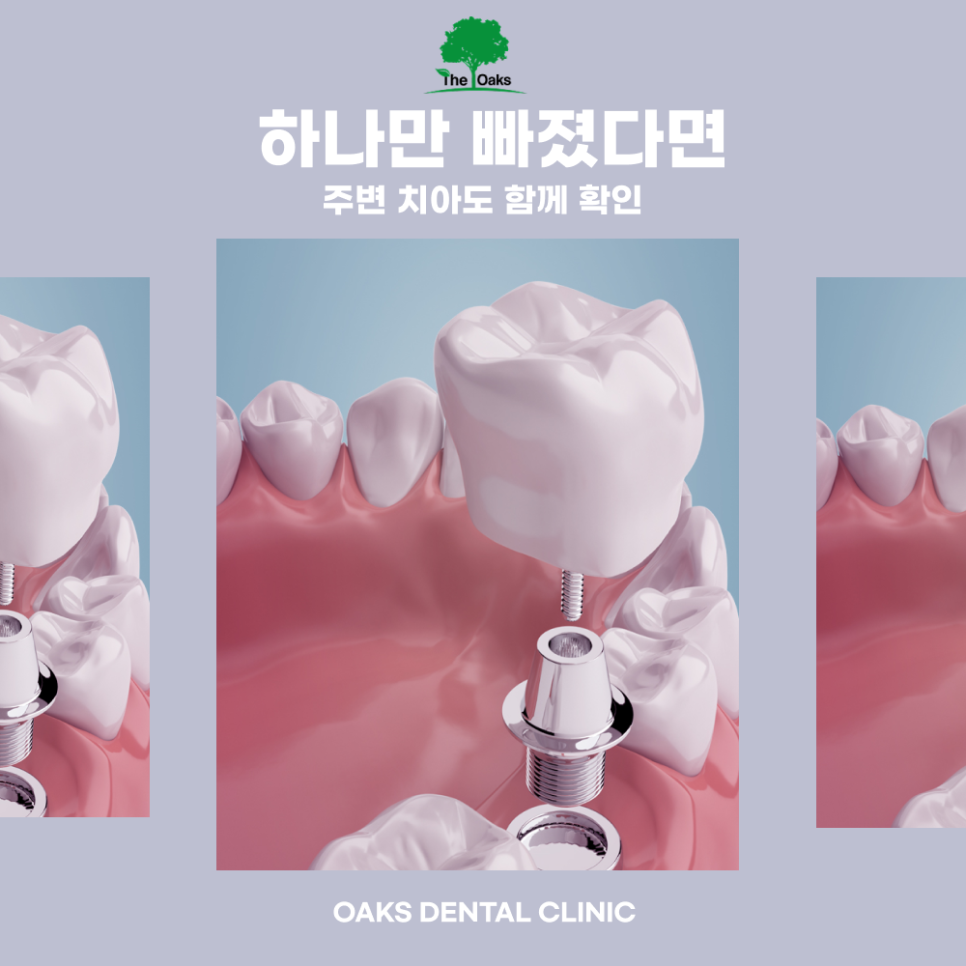 도곡동치과 임플란트종류 나에게 맞는 방법은? 관련 이미지 2