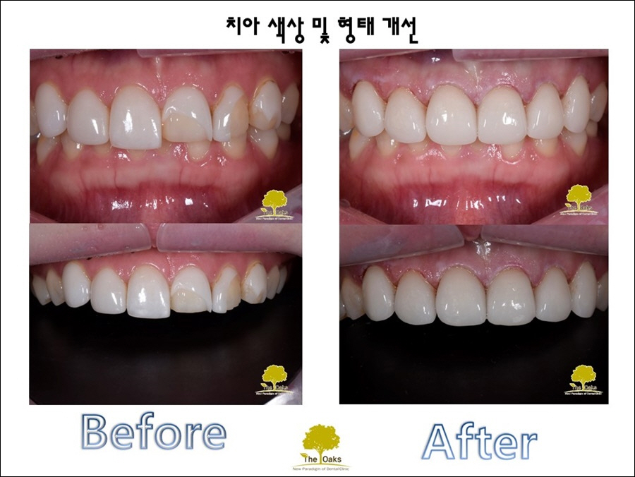 강남라미네이트 환하고 가지런한 치열 관련 이미지 2