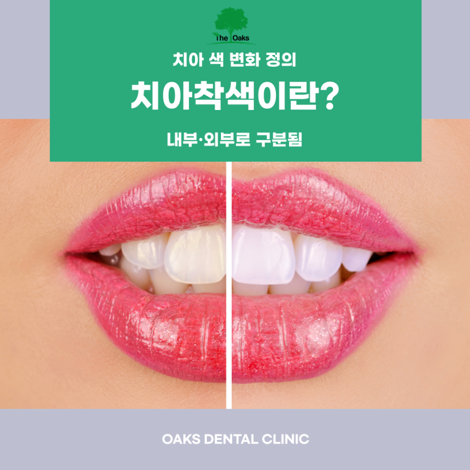 신사동치과 치아착색 원인부터 깨끗하게 되돌리는 방법까지 관련 이미지 1