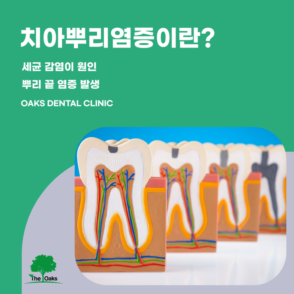 자곡동치과 치아뿌리염증 조기 치료로 자연치아를 지키는 방법 관련 이미지 1