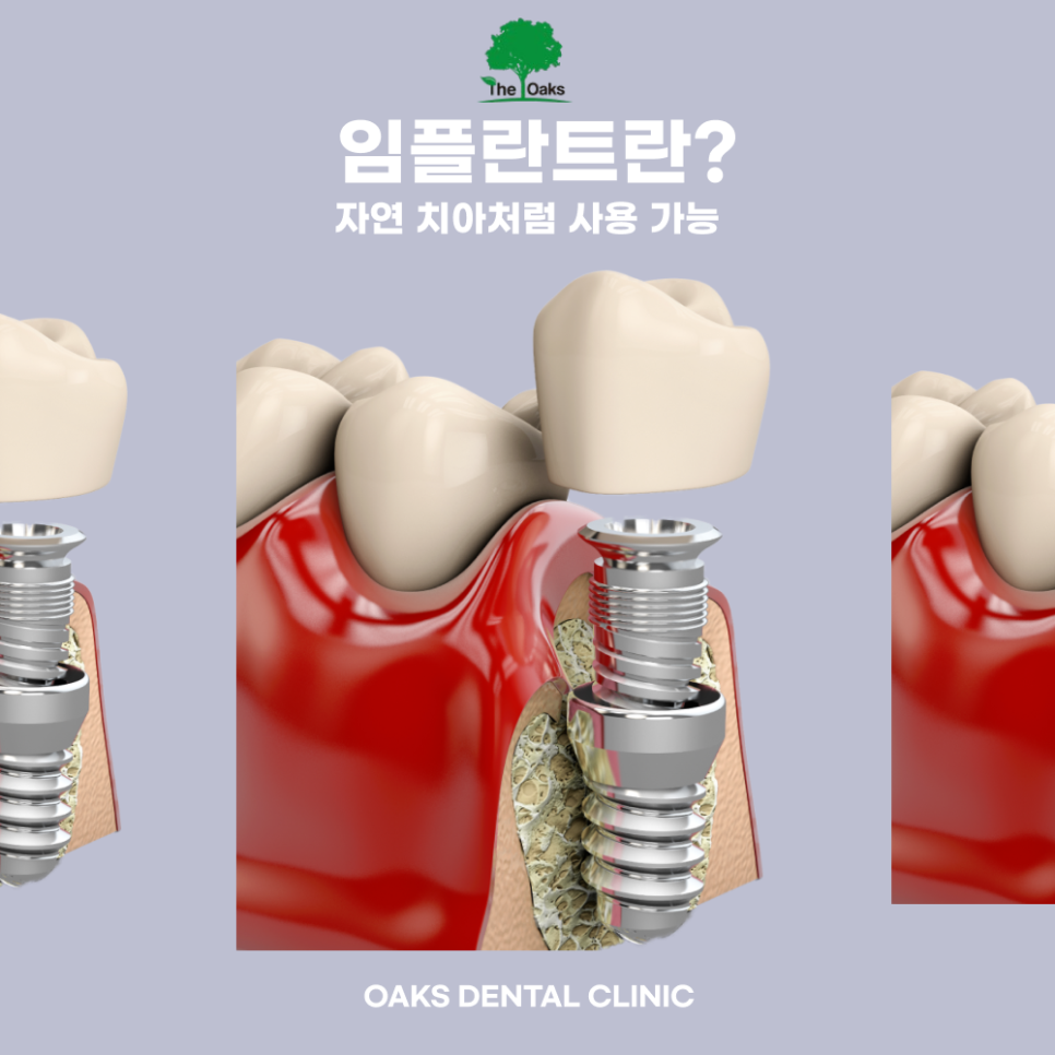 청담동치과 임플란트수술 꼭 알아야 할 전 과정 정리 관련 이미지 1