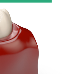 신사동치과 임플란트부작용 미리 알수록 예방할 수 있습니다 관련 이미지 13