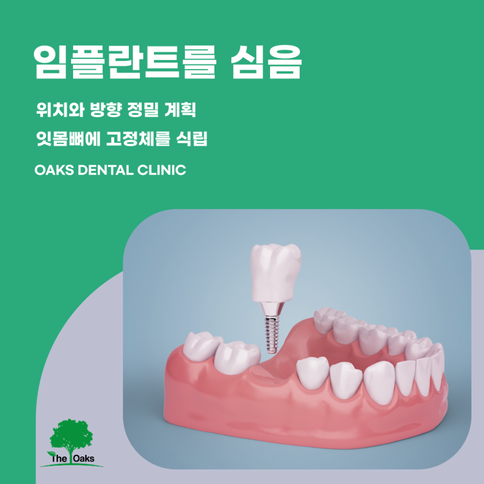 개포동치과 임플란트과정 단계별로 알아보는 치료의 흐름 관련 이미지 2