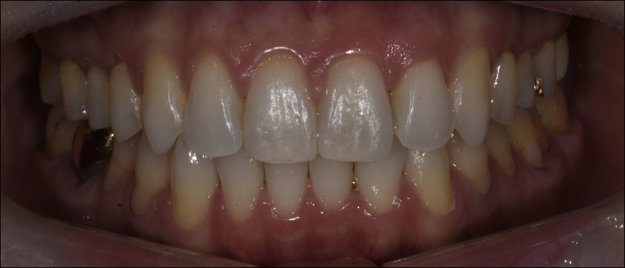 강남역치아교정 마스크 당당히 벗어요! 관련 이미지 2