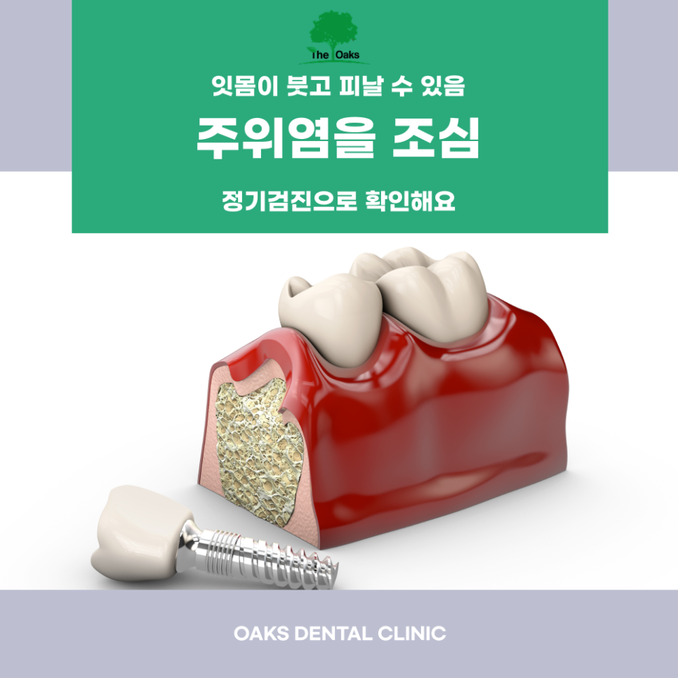 교대역치과 임플란트부작용 어떤 증상이 있을까요? 관련 이미지 4