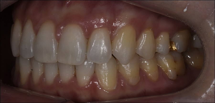 강남역치아교정 마스크 당당히 벗어요! 관련 이미지 4