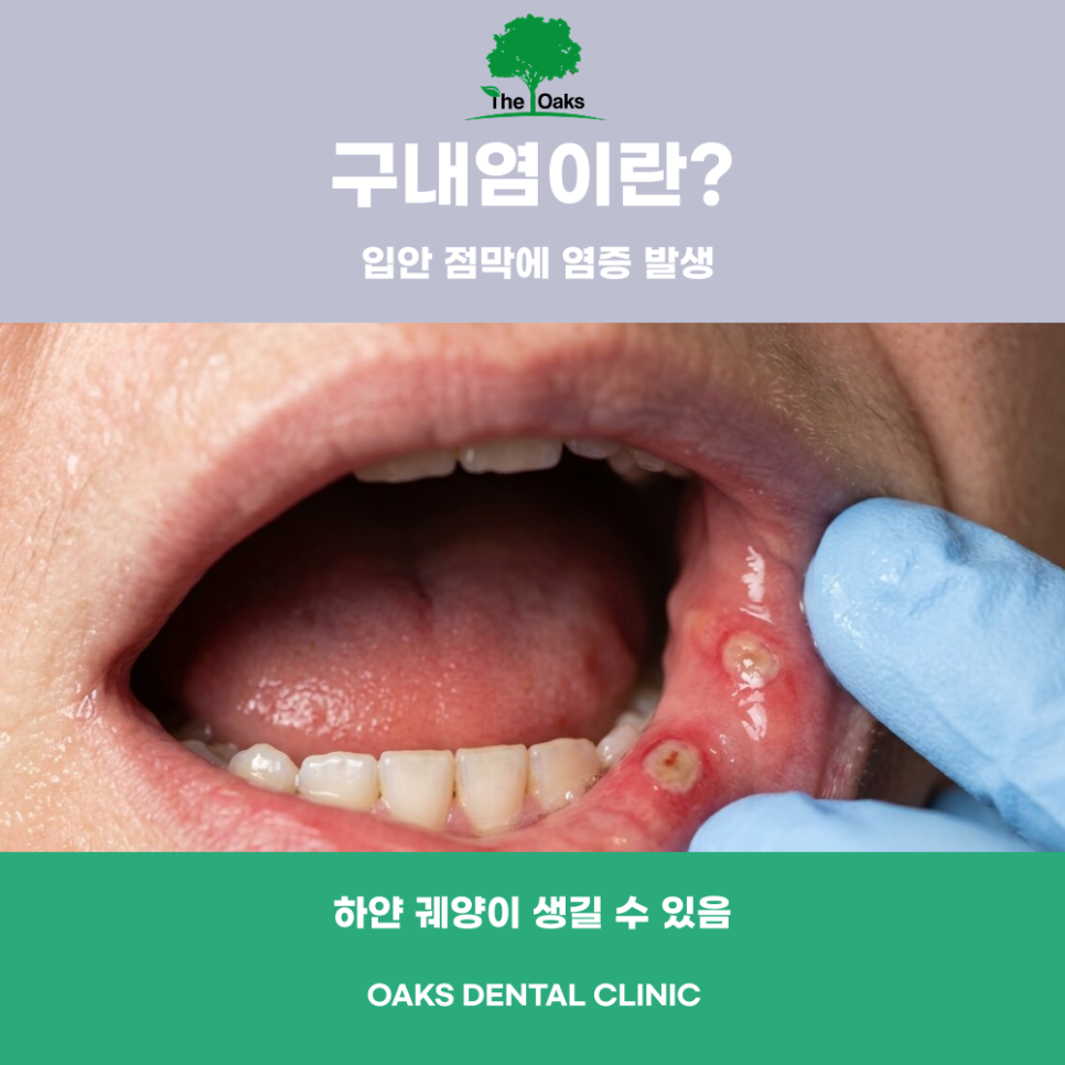 압구정동치과 구내염이 생겼을 때 알아두면 좋은 관리법 관련 이미지 1