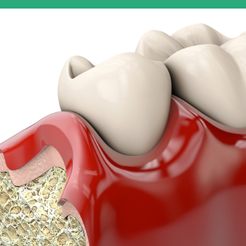 신사동치과 임플란트부작용 미리 알수록 예방할 수 있습니다 관련 이미지 12