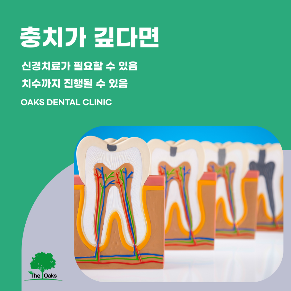 서초역치과 신경치료 전 알아두면 좋은 것들 관련 이미지 2