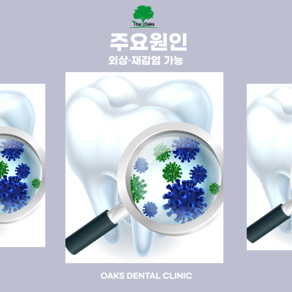 자곡동치과 치아뿌리염증 조기 치료로 자연치아를 지키는 방법 관련 이미지 2