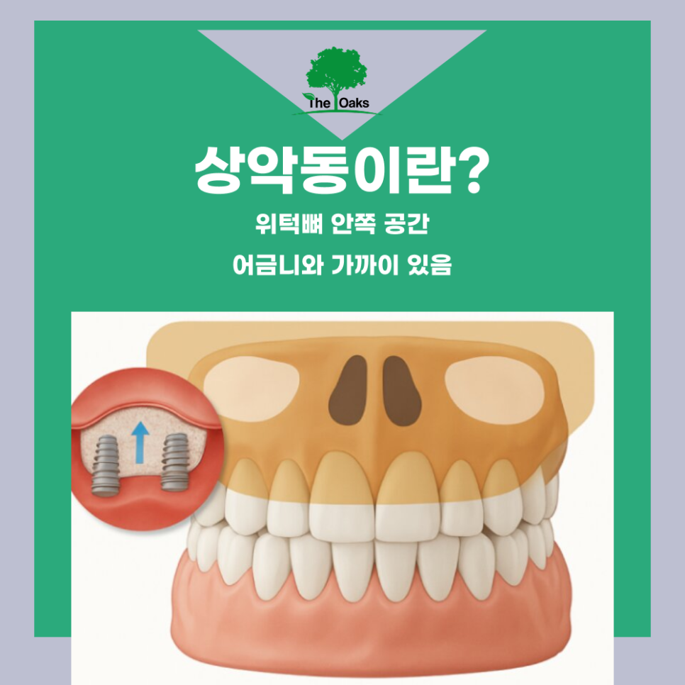 개포동치과 상악동거상술은 어떻게 진행될까요? 관련 이미지 1