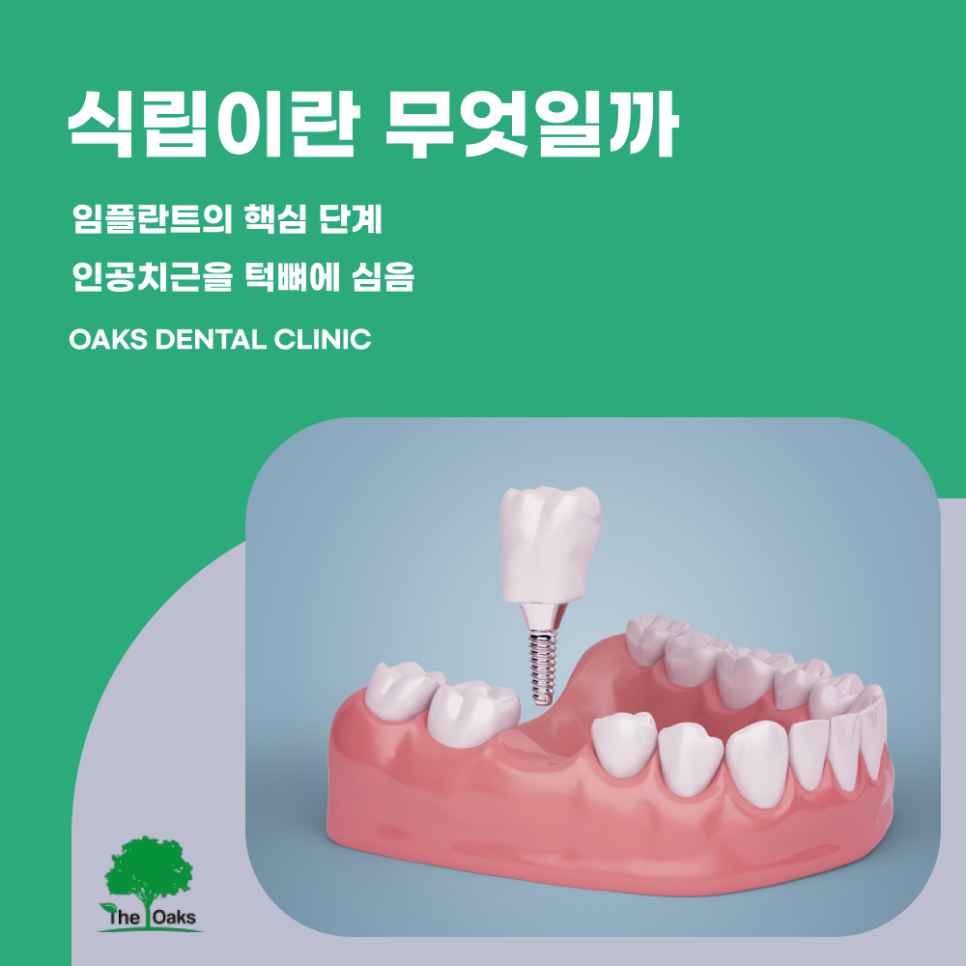 신사동치과 임플란트식립 어떤 과정을 거치나요 관련 이미지 1