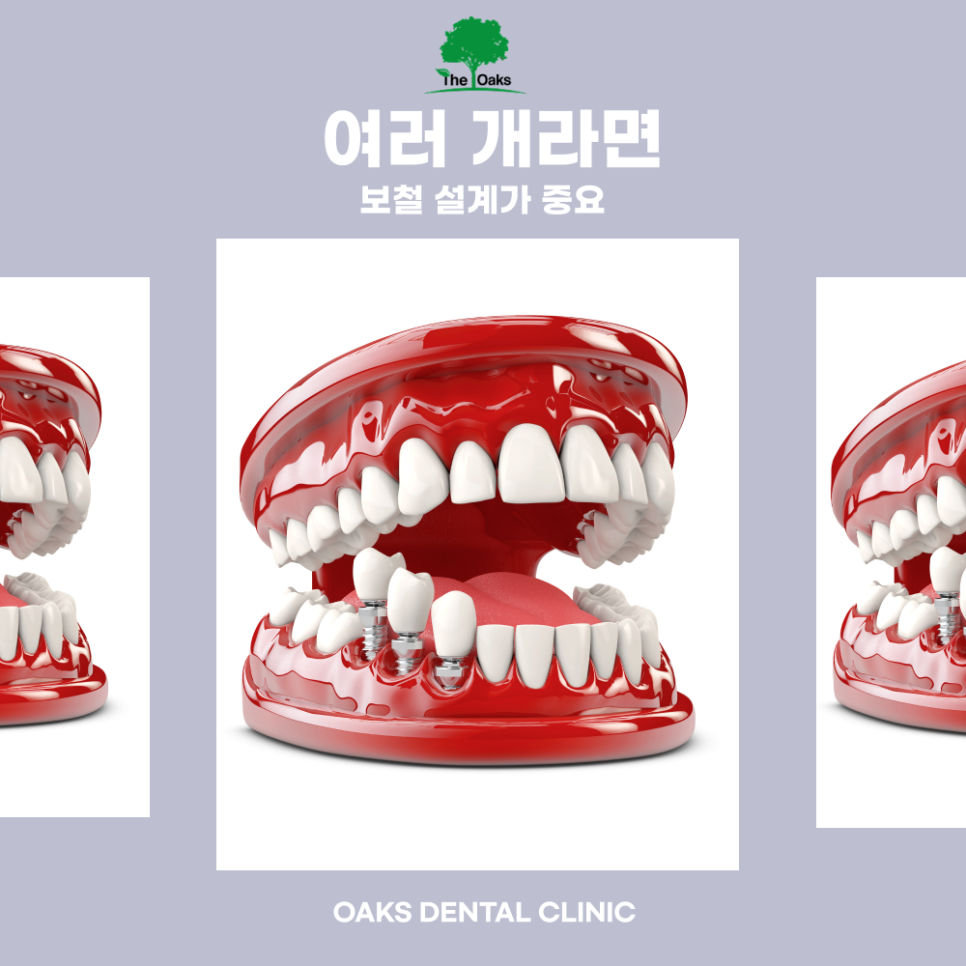 도곡동치과 임플란트종류 나에게 맞는 방법은? 관련 이미지 3