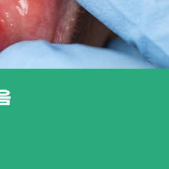 압구정동치과 구내염이 생겼을 때 알아두면 좋은 관리법 관련 이미지 16