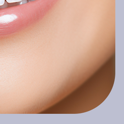 강남 원데이 라미네이트 하루 만에 달라지는 자연스러운 미소의 변화 관련 이미지 16