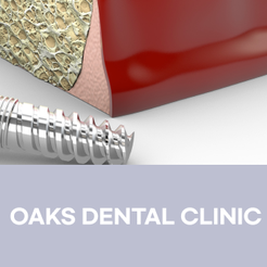 신사동치과 임플란트부작용 미리 알수록 예방할 수 있습니다 관련 이미지 15